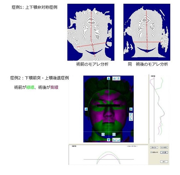 レーザー光による顔面の三次元解析
