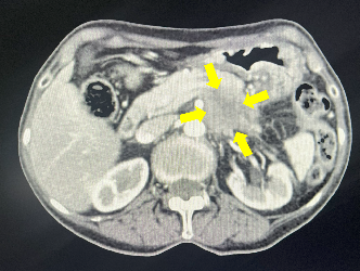 胆膵（膵癌）