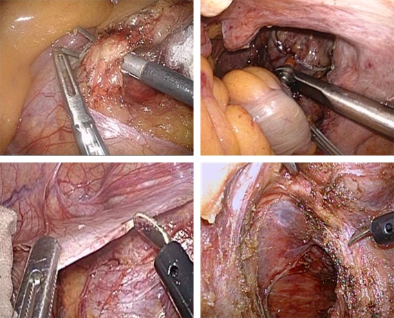 腹腔鏡手術（低侵襲で正確な手術）