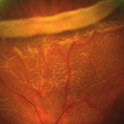 retinaltear.jpeg