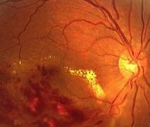 網膜中心静脈分枝閉塞症の画像
